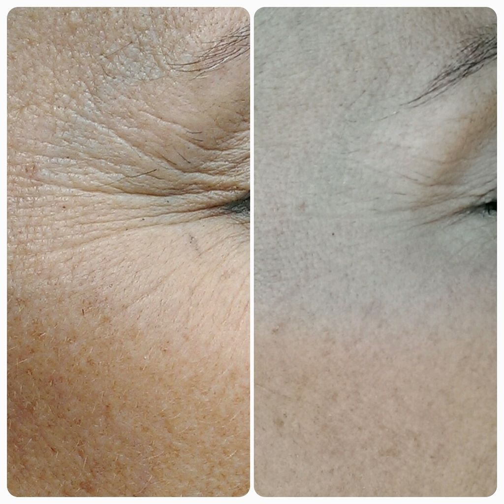 Understanding the Nature of Skin Cancer