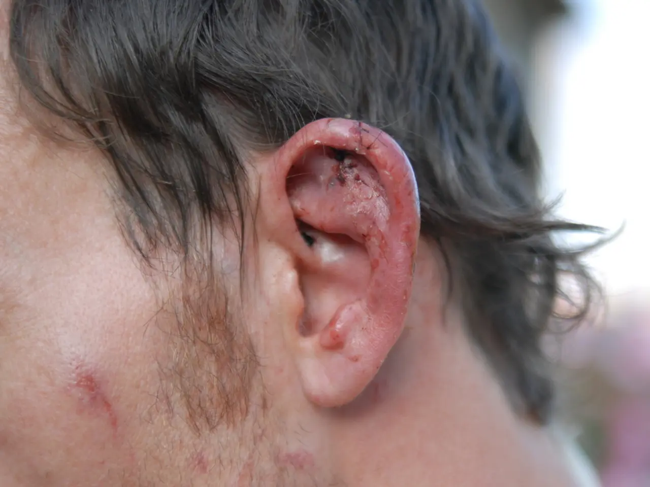 Hematoma Breakdown: Description, Classifications, Remedies, and Visual Representations