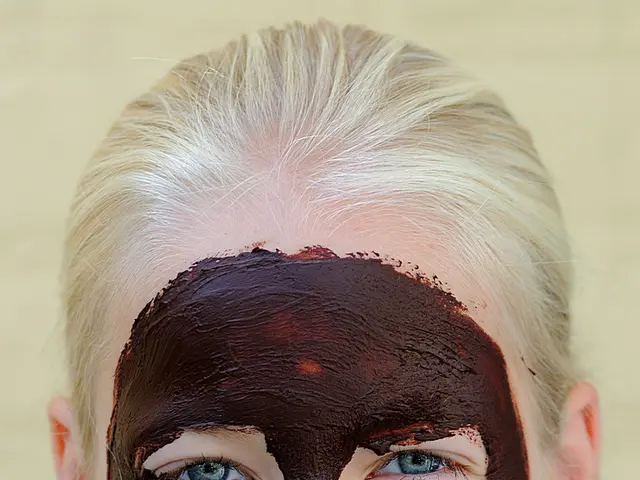 Melasma in dark skin: Origins, remedy, and additional insights