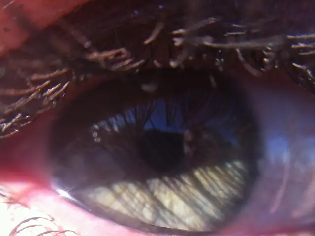 treatment and prognosis of vernal conjunctivitis